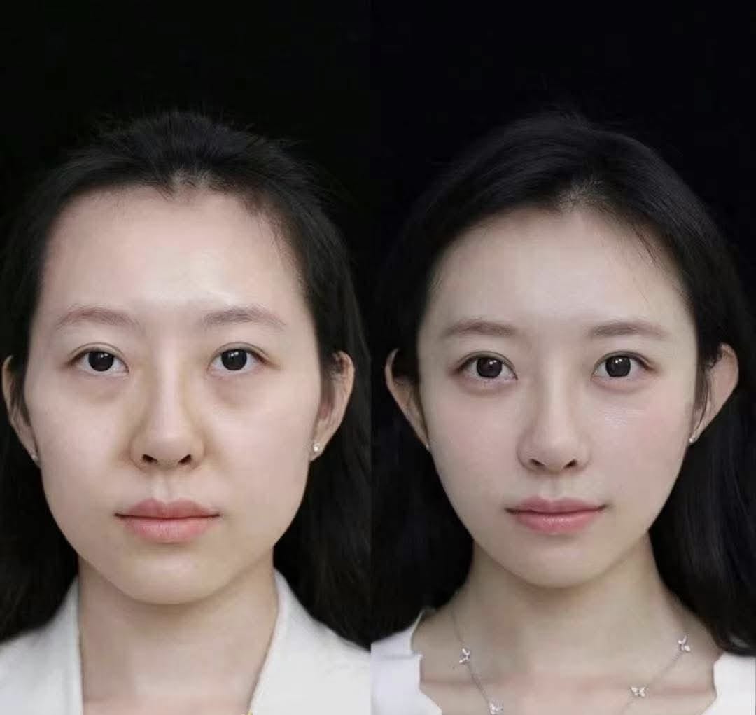 Skin Lifting & Radiance before and after result