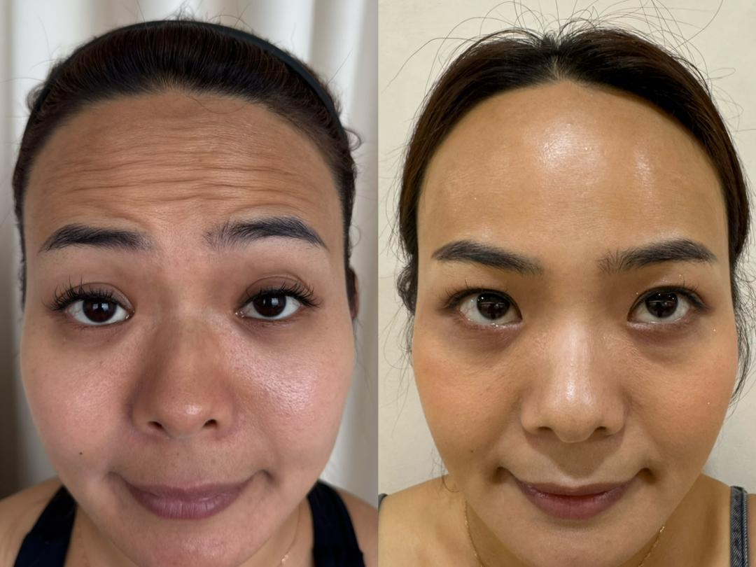Forehead Lines & Texture before and after result