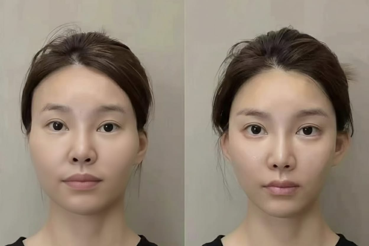 Facial Contour & Lift before and after result