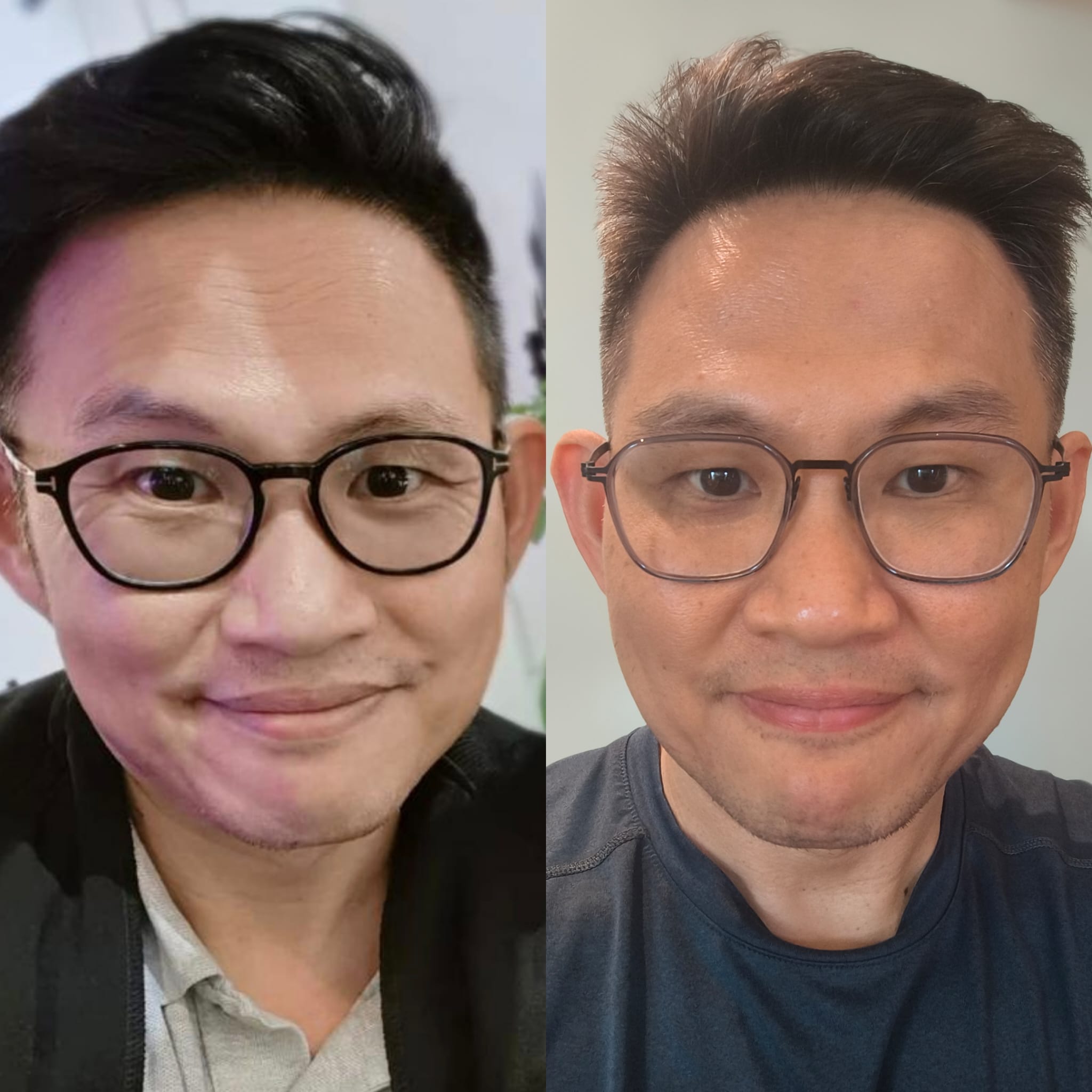 Forehead Lines & Texture before and after result